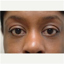 Eyelid Surgery After Photo by Franklin Richards, MD; Bethesda, MD - Case 46123