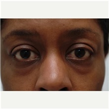 Eyelid Surgery Before Photo by Franklin Richards, MD; Bethesda, MD - Case 46123