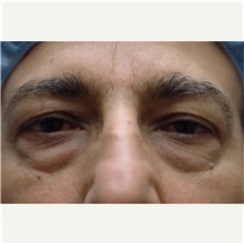 Eyelid Surgery Before Photo by Franklin Richards, MD; Bethesda, MD - Case 46124