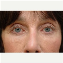 Eyelid Surgery After Photo by Franklin Richards, MD; Bethesda, MD - Case 46125