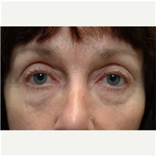 Eyelid Surgery Before Photo by Franklin Richards, MD; Bethesda, MD - Case 46125