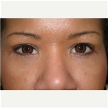 Eyelid Surgery After Photo by Franklin Richards, MD; Bethesda, MD - Case 46126