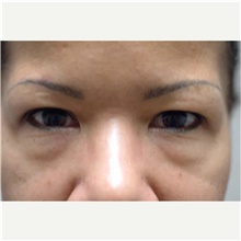 Eyelid Surgery Before Photo by Franklin Richards, MD; Bethesda, MD - Case 46126