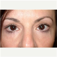 Eyelid Surgery After Photo by Franklin Richards, MD; Bethesda, MD - Case 46127