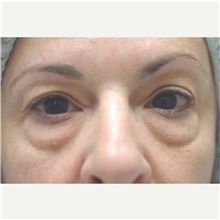 Eyelid Surgery Before Photo by Franklin Richards, MD; Bethesda, MD - Case 46127