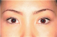 Eyelid Surgery After Photo by Franklin Richards, MD; Bethesda, MD - Case 46129
