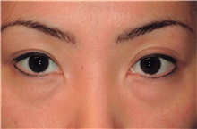 Eyelid Surgery Before Photo by Franklin Richards, MD; Bethesda, MD - Case 46129