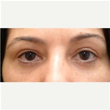 Eyelid Surgery After Photo by Franklin Richards, MD; Bethesda, MD - Case 46130