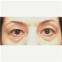 Eyelid Surgery Before Photo by Franklin Richards, MD; Bethesda, MD - Case 46130