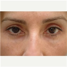 Eyelid Surgery After Photo by Franklin Richards, MD; Bethesda, MD - Case 46131
