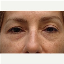 Eyelid Surgery Before Photo by Franklin Richards, MD; Bethesda, MD - Case 46131