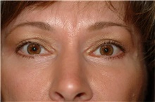 Eyelid Surgery After Photo by Franklin Richards, MD; Bethesda, MD - Case 46132