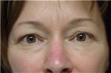 Eyelid Surgery Before Photo by Franklin Richards, MD; Bethesda, MD - Case 46132