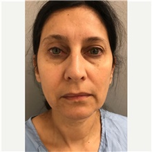Facelift Before Photo by Franklin Richards, MD; Bethesda, MD - Case 46133