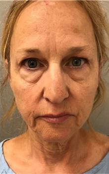 Facelift Before Photo by Franklin Richards, MD; Bethesda, MD - Case 46134