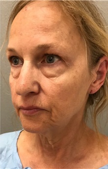 Facelift Before Photo by Franklin Richards, MD; Bethesda, MD - Case 46134