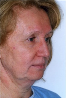 Facelift Before Photo by Franklin Richards, MD; Bethesda, MD - Case 46135