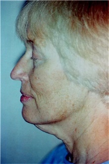 Facelift Before Photo by Franklin Richards, MD; Bethesda, MD - Case 46136