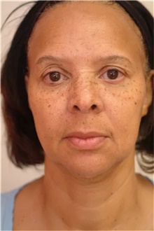 Facelift Before Photo by Franklin Richards, MD; Bethesda, MD - Case 46137