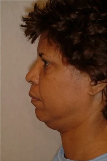 Facelift Before Photo by Franklin Richards, MD; Bethesda, MD - Case 46137