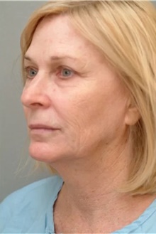 Facelift Before Photo by Franklin Richards, MD; Bethesda, MD - Case 46138