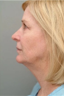 Facelift Before Photo by Franklin Richards, MD; Bethesda, MD - Case 46138