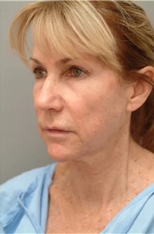 Facelift Before Photo by Franklin Richards, MD; Bethesda, MD - Case 46140