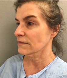 Facelift Before Photo by Franklin Richards, MD; Bethesda, MD - Case 46141