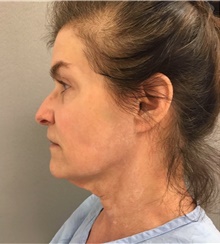 Facelift Before Photo by Franklin Richards, MD; Bethesda, MD - Case 46141