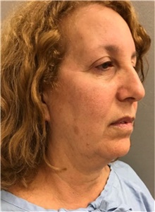 Facelift Before Photo by Franklin Richards, MD; Bethesda, MD - Case 46142