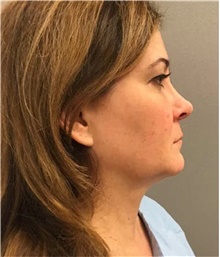Facelift Before Photo by Franklin Richards, MD; Bethesda, MD - Case 46143