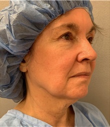 Facelift Before Photo by Franklin Richards, MD; Bethesda, MD - Case 46144