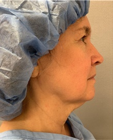 Facelift Before Photo by Franklin Richards, MD; Bethesda, MD - Case 46144