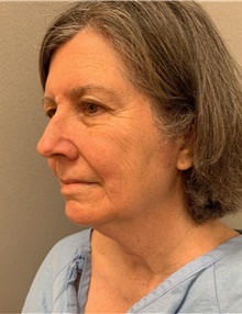 Facelift Before Photo by Franklin Richards, MD; Bethesda, MD - Case 46145