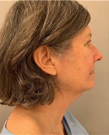 Facelift Before Photo by Franklin Richards, MD; Bethesda, MD - Case 46145