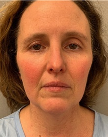 Facelift Before Photo by Franklin Richards, MD; Bethesda, MD - Case 46146