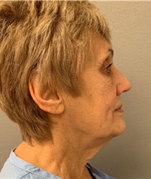 Facelift Before Photo by Franklin Richards, MD; Bethesda, MD - Case 46148