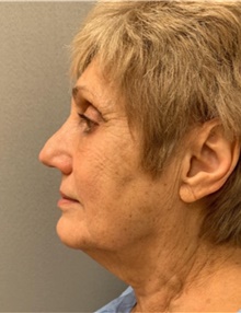 Facelift Before Photo by Franklin Richards, MD; Bethesda, MD - Case 46148
