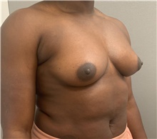 Breast Augmentation Before Photo by Franklin Richards, MD; Bethesda, MD - Case 46176