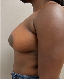 Breast Augmentation After Photo by Franklin Richards, MD; Bethesda, MD - Case 46176