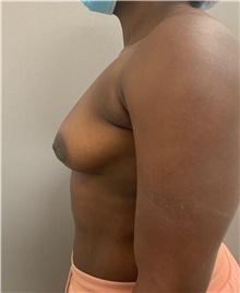 Breast Augmentation Before Photo by Franklin Richards, MD; Bethesda, MD - Case 46176