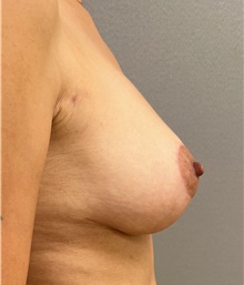 Breast Lift After Photo by Franklin Richards, MD; Bethesda, MD - Case 46177