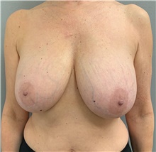 Breast Reduction Before Photo by Franklin Richards, MD; Bethesda, MD - Case 46184