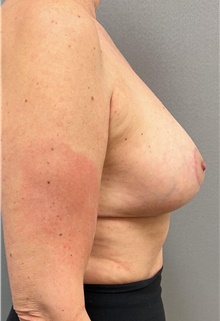Breast Reduction After Photo by Franklin Richards, MD; Bethesda, MD - Case 46184