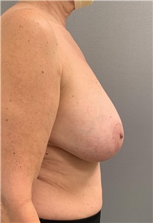 Breast Reduction Before Photo by Franklin Richards, MD; Bethesda, MD - Case 46184