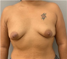 Breast Augmentation Before Photo by Franklin Richards, MD; Bethesda, MD - Case 46185
