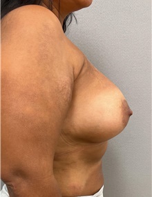 Breast Augmentation After Photo by Franklin Richards, MD; Bethesda, MD - Case 46185