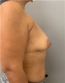 Breast Augmentation Before Photo by Franklin Richards, MD; Bethesda, MD - Case 46185