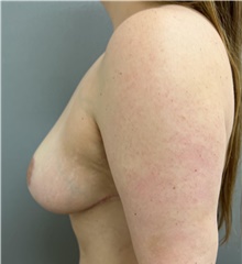 Breast Lift After Photo by Franklin Richards, MD; Bethesda, MD - Case 46301