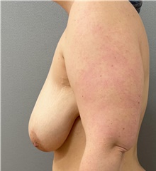 Breast Lift Before Photo by Franklin Richards, MD; Bethesda, MD - Case 46301